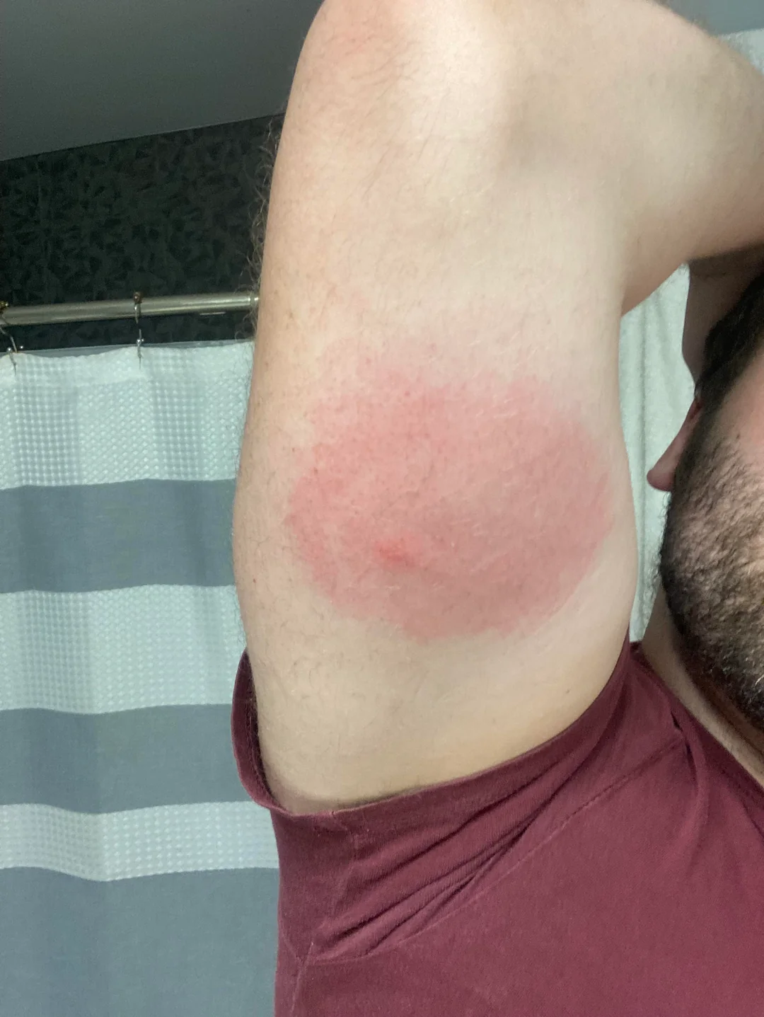 Tick Bite V0 Ig7Qz4Axtq0B1